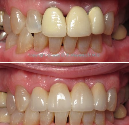 Dental-Crown-before-After