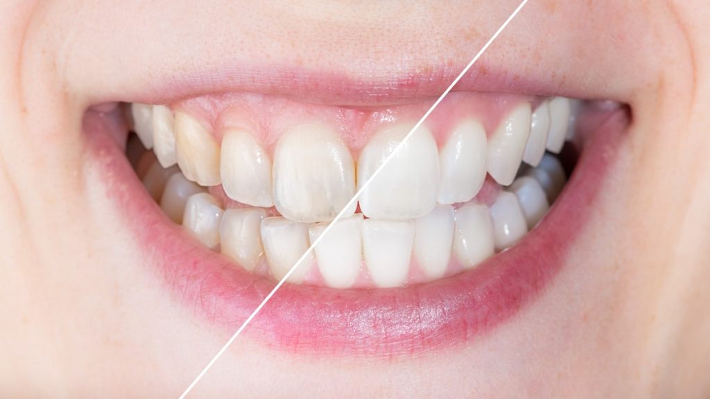 Some dentists use dental bonding for enamel loss