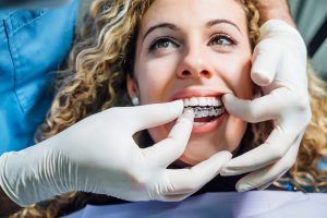 Dentist hands placing Invisalign retainers on beautiful woman's teeth.
